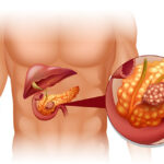 Pancreatico biliary diseases 